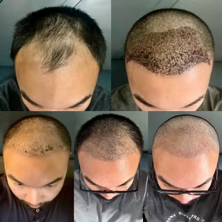 One month post FUE hair transplant update! Look at that progress!!! 🪮✨🙌🏻 

______________________