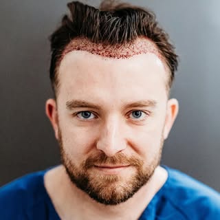 Post Hair Transplant Surgery From All Angles 📐

Check out the INCREDIBLE work done by our wonderful