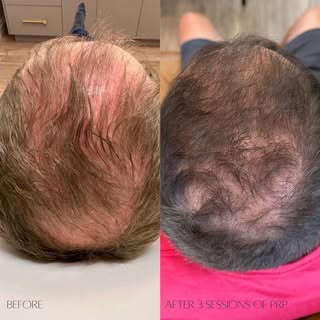 ✦ PLATELET-RICH PLASMA ✦ 

Incredible results after 3 treatment sessions! Our patient is absolutely 