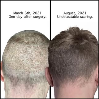 FUE HAIR TRANSPLANT

Follicular Unit Extraction (FUE) is a type of hair transplant done by taking in