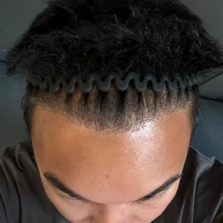 Swipe to see how much can change in just 8 months post-FUE hair transplant! 👨‍🦲➡️🧑‍🦱 

Results l