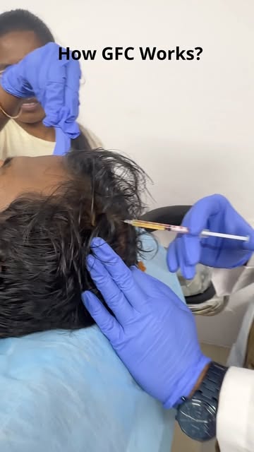 GFC for hair fall — but how does it actually work? 💉🩸

Your own blood is processed to obtain conce