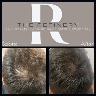 After just 2 sessions of scalp micro-pigmentation.
SMP can be so subtle, that it goes completely und