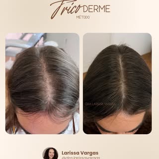 Minha paciente chegou no meu consultório já relatando notar as falhas quando o cabelo está molhado. 