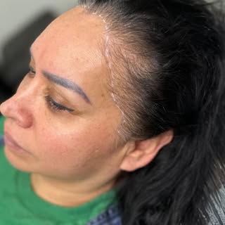 Scalp Micropigmentation (SMP) is not limited to men; it also benefits women by creating the appearan