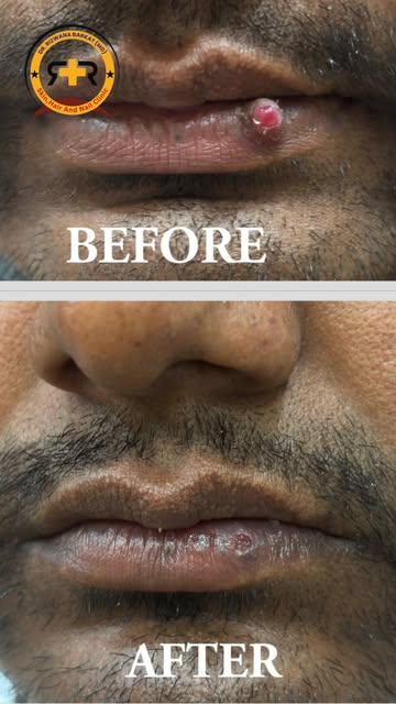 A small growth on the lip may need more than just a cosmetic fix.

This is a case of Pyogenic Granul