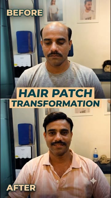 From Goa to Pune for a Confidence Transformation! ✨

“Hair patch transformation for baldness at The 