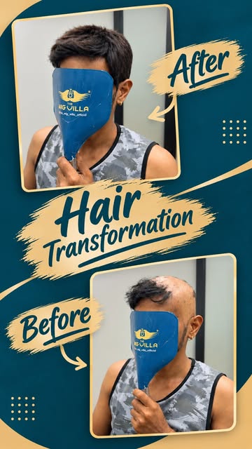 From visible baldness to a natural-looking transformation! ✨

A great hair transformation can change