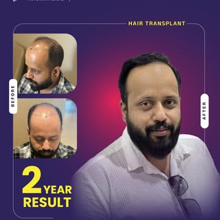 Sometimes, the most meaningful transformation isn’t just a fuller hairline, it’s the confidence that