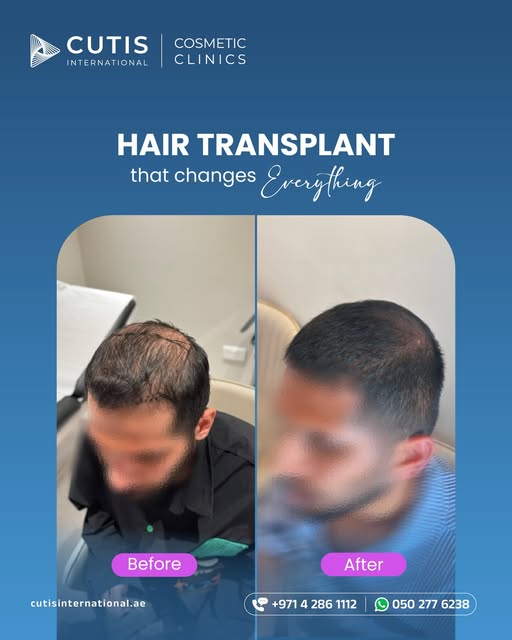 From thinning areas to improved coverage and density, hair transplantation offers a long term approa