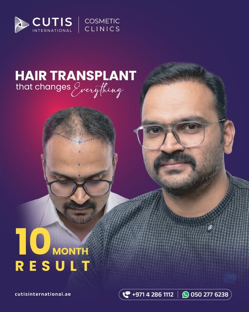 The before tells the concern. The after shows the progress.

Hair transplantation is about more than