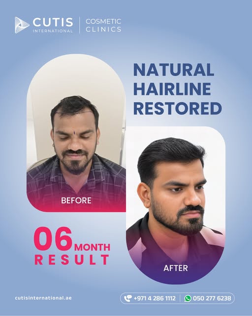 If hair loss has changed the way you feel about your appearance, a personalized hair transplant plan