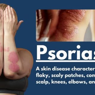 Psoriasis is a chronic skin condition causing itchy, painful dry patches, primarily on the scalp, kn