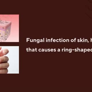 Ringworm is a fungal infection of the skin, hair, or nails that causes a ringshaped rash. The rash i