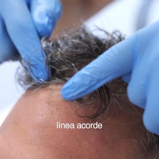 La línea frontal no se diseña igual para todos.  Cada paciente tiene unas facciones, una edad y un t
