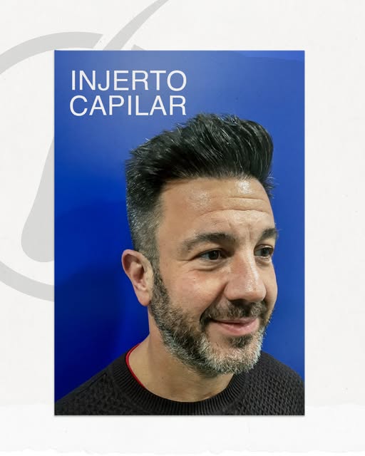 Hoy compartimos el antes y después de uno de nuestros pacientes tras su injerto capilar.

👉​Un resu