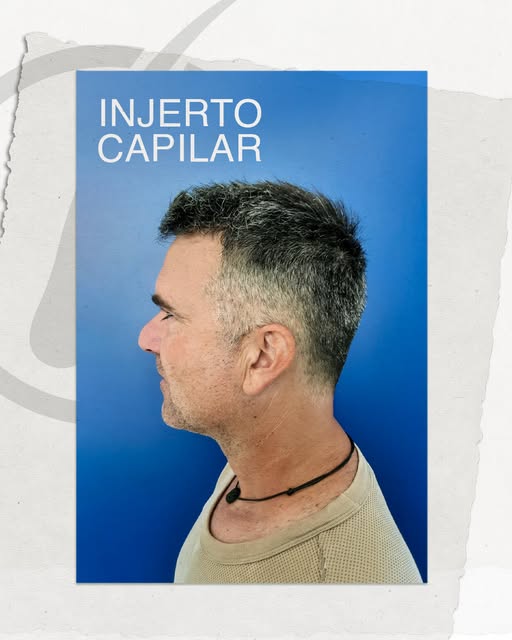 Cada injerto capilar cuenta una historia diferente. 🤍

👉 Compartimos la evolución de uno de nuestr