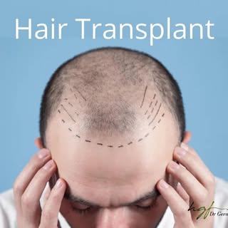 Hair transplant is a surgical procedure that moves hair follicles from one part of the scalp or body
