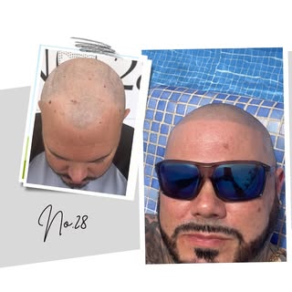 😎 Holiday Ready😎 Are you? Interested in SMP treatment WhatsApp Any Questions you have to 073692653