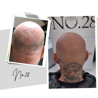 🔥SMP will knock the years off😂Interested in SMP treatment WhatsApp Any Questions you have to 07369