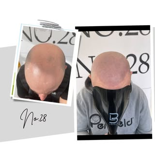 🧢 no caps needed here 🧢 Interested in SMP treatment WhatsApp Any Questions you have to 07369265351