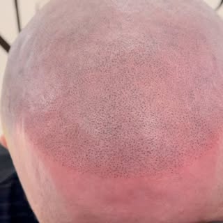 🔥Hairlines back like it never left🔥Still settling in to go redness will go within 24hours👌Interes