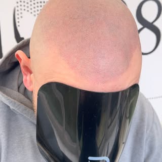 ☀️That hairline & shades combo🕶️ Interested in SMP treatment WhatsApp Any Questions you have to 073