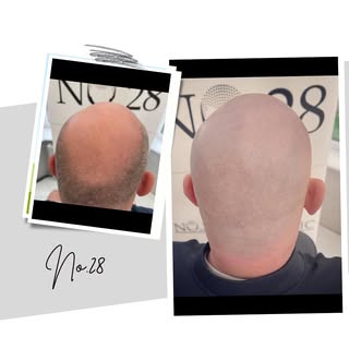 🔥 SMP will cover your crown area giving you the look of a full head of shaved hair 🔥Interested in 