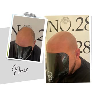 ✍️Here We Go✍️ Last session signed off for this Topman✍️If we can help with your Hair loss WhatsApp 