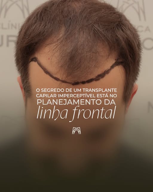 Quando as pessoas observam um transplante capilar executado no Padrão Muricy, dificilmente conseguem