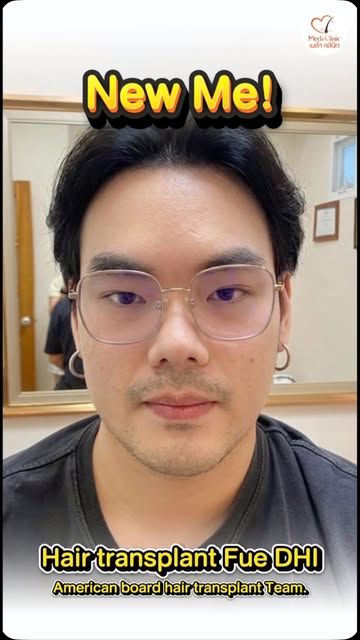 ปัญหาผมบาง ผมร่วง หรือแนวผมร่น อาจทำให้ขาดความมั่นใจ การปลูกผมจึงเป็นอีกหนึ่งทางเลือกในการฟื้นฟูเส้น