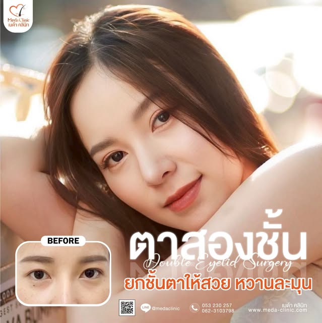 ✨ ตาสองชั้นสวยละมุน เพิ่มเสน่ห์ให้ดวงตาอย่างเป็นธรรมชาติ ✨

ดวงตาคือเสน่ห์ที่ช่วยเติมความมั่นใจให้กั