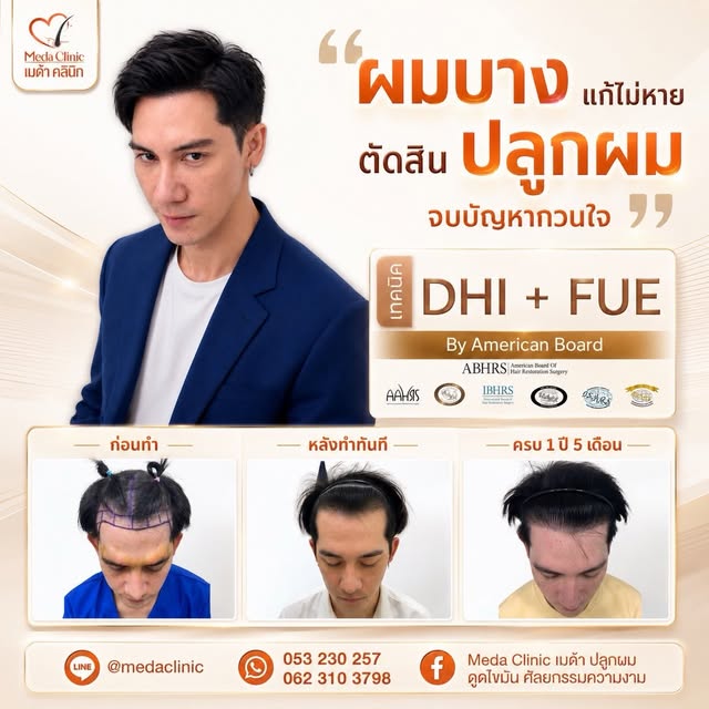 ✨ ผมบาง แก้ไม่หาย…ตัดสินใจ “ปลูกผม” จบปัญหากวนใจ ✨

ปัญหาผมบาง หน้าผากกว้าง หรือแนวผมถอย อาจทำให้หลา