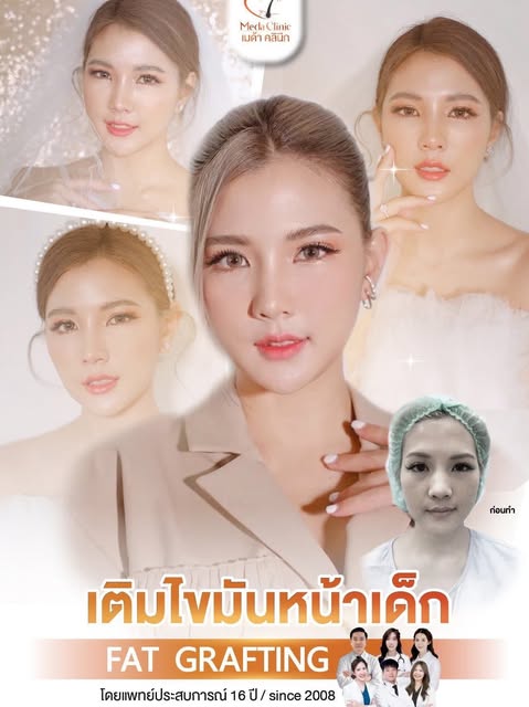 💉 หน้าเด็กไม่พัก เติมปุ๊บใสปั๊บ 💖

✨การ เติมไขมันหน้าเด็ก คือการดูดไขมันจากส่วนอื่นของร่างกาย (เช่