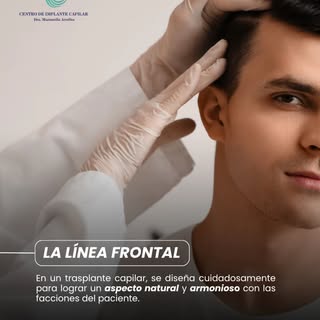 ✍️ La línea frontal es uno de los elementos más importantes en un trasplante capilar, ya que define 