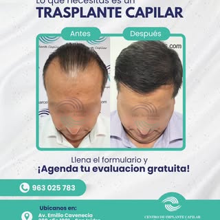¿La caída de cabello cada vez es más evidente?

Un trasplante capilar puede ayudarte a recuperar tu 