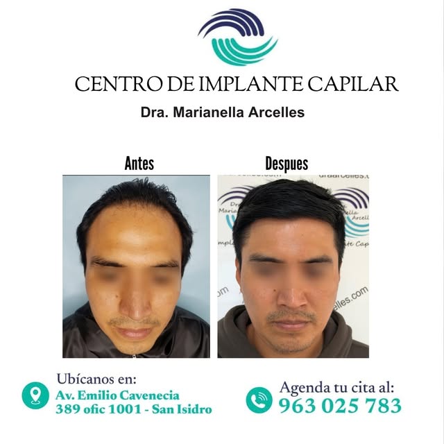 ¿La pérdida de cabello está afectando tu apariencia? El trasplante capilar con la técnica FUE, puede