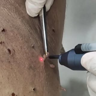 Instant skin tags removal | No pain No scar at Dr Tamoor's Aesthetic Clinic Islamabad #skintag #skin
