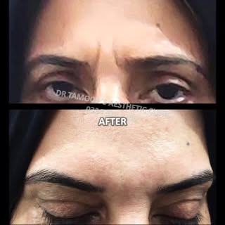 Frown Lines Treatment at Dr Tamoor's Aesthetic Clinic Islamabad #frownlines #frownlinesbotox #botox 