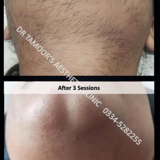 #laserhairremoval #hairremoval #pocs #islamabad #aesthetic #skincare #drtamoor