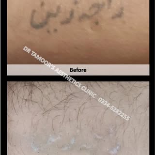 Laser Tattoo Removal at Dr Tamoor's Aesthetic Clinic Islamabad #lasertattooremoval #tattooremoval #t