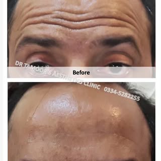 Anti wrinkle Treatment at Dr Tamoor's Aesthetic Clinic Islamabad