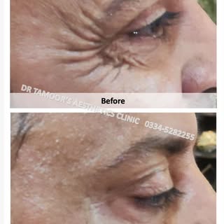 Anti wrinkle Treatment at Dr Tamoor's Aesthetic Clinic Islamabad #botox #islamabad