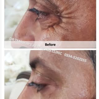 Anti wrinkle Treatment at Dr Tamoor's Aesthetic Clinic Islamabad #islamabad #botox