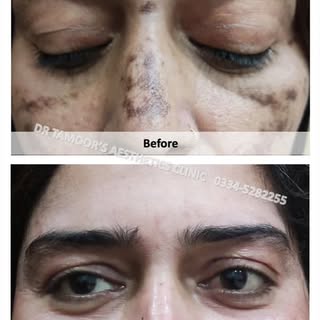 Hyperpigmentation treatment at Dr Tamoor's Aesthetic Clinic Islamabad #melasma #picolaser #qswitch #