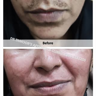 Hyperpigmentation treatment at Dr Tamoor's Aesthetic Clinic Islamabad #melasma #picolaser #qswitch #