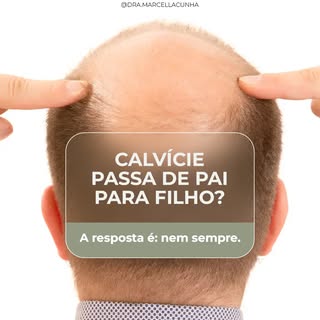 Essa é uma das perguntas que mais escuto no consultório.

A calvície de padrão masculino, chamada de