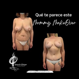 🌸 ¡Recupera tu confianza y siéntete radiante con un increíble Mommy Makeover! 🌸

¿Eres una mujer q