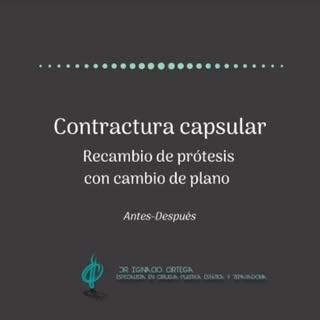 La #contracturacapsular es una de las complicaciones que pueden ocurrir en los #aumentodepecho. La m