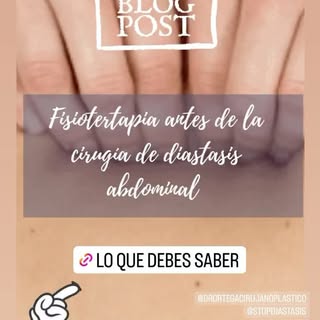 La #diastasisabdominal es la separación de los músculos rectos del abdomen que se da sobre todo desp